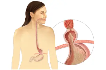 Mide Fıtığı Belirtileri ve Tedavisi