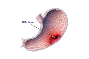 Mide Kanseri Belirtileri ve Tedavisi